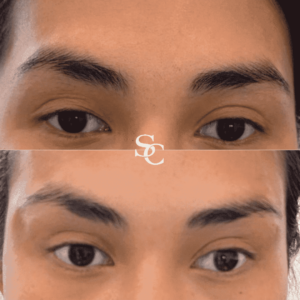Tired Eyes Treatment by Skin Club