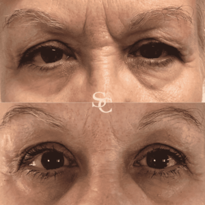 Tired Eyes Treatment Melbourne