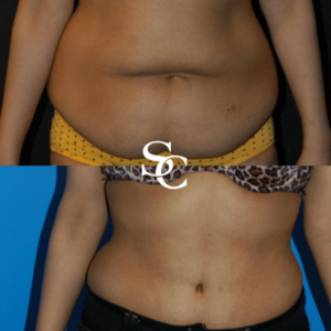 Tummy Tuck Surgery Before And After