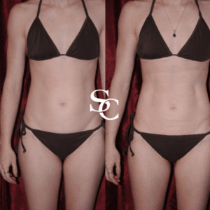 Vaser4D -Liposuction-Before-and-After