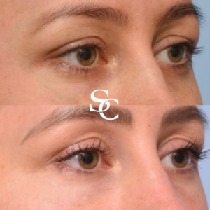 Veins Around The Eyes Before and After