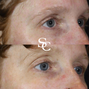 Veins Around The Eyes Treatment by Skin Club