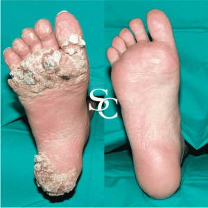 Verruca Treatment Before and After