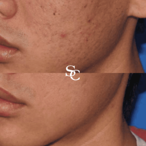 Acne Treatment Result