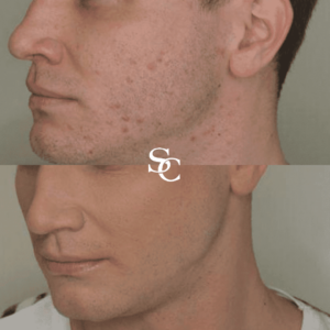 Full Face Rejuvenation By Skin Club