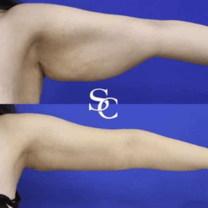 Arm Liposuction Before And After