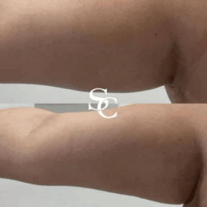 Arm Liposuction Arm Liposuction Before And After