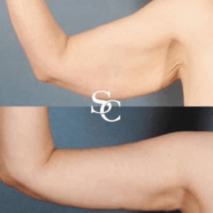 Arm Liposuction Clinc In Melbourne