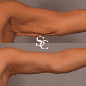 Arm Liposuction Treatment in Melbourne