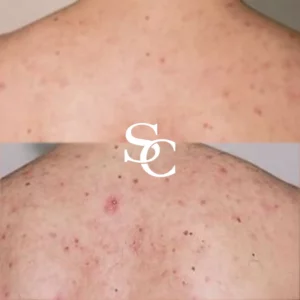 Back Acne Scars By Skin Club