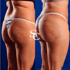 Brazilian Butt Lift By Skin Club