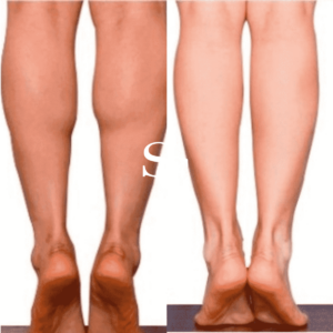 Calf Liposuction Before And After