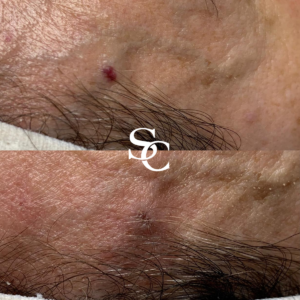 Cherry Angioma Removal Before and After