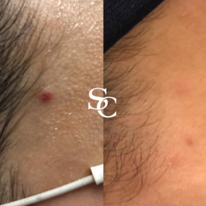 Cherry Angioma Removal Treatment Melbourne