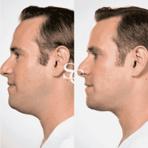 Chin Liposuction Treatment in Melbourne