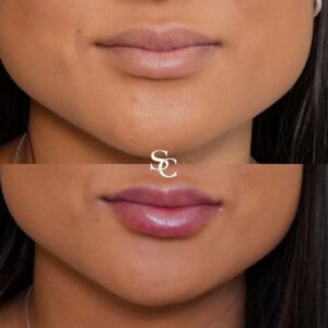 Dermal fillers Before and After