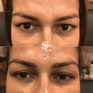 Fox Eye Thread Lift Before And After