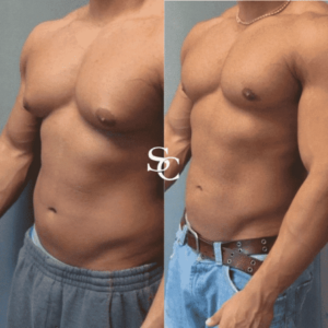 Man Boobs Surgery (Gynecomastia) by Skin Club