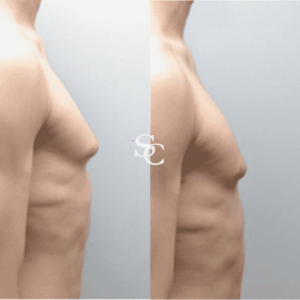 Man Boobs Surgery (Gynecomastia)Treatment