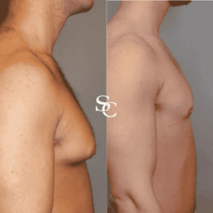 Man Boobs Surgery (Gynecomastia) Before And After