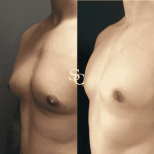 Man Boobs Surgery (Gynecomastia) Result