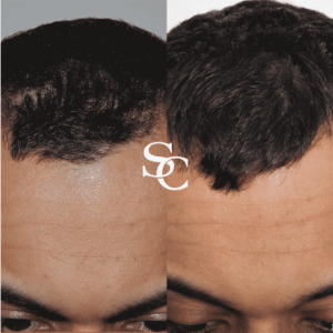PRP Hair Loss by Skin Club