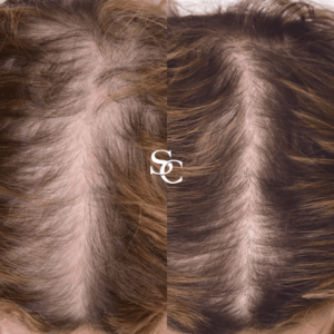 PRP Hair Loss Treatment in Melbourne