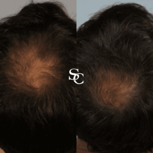 PRP Hair Loss Clinic in Melbourne