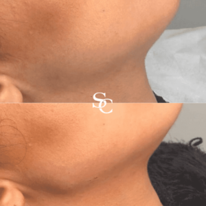 Jaw Fillers By Skin Club