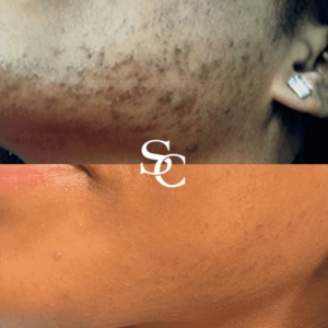 Laser freckle removal Result