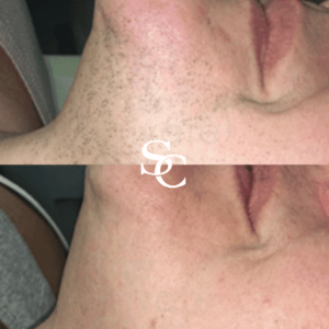 Laser freckle removal Treatment In Melbourne