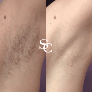 Laser freckle removal Before And After