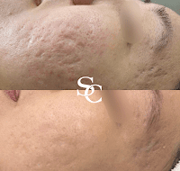 Laser Skin Resurfacing Before And After