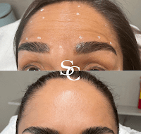 Laser Skin Resurfacing By Skin Club