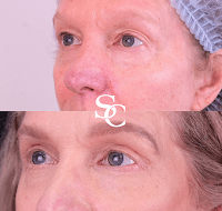 Laser Skin Resurfacing Treatment In Melbourne