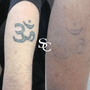 Laser Tattoo Removal Result