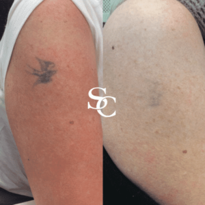 Laser Tattoo Removal Before & After By Skin Club Cosmetic Doctors
