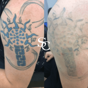 Laser Tattoo Removal In Melbourne