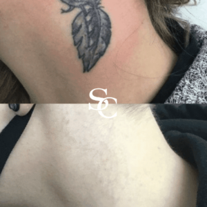 expert of Laser Tattoo Removal