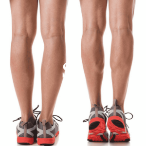 Leg Liposuction Result