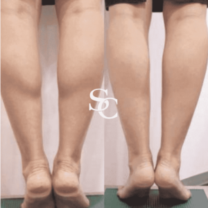 Leg Liposuction By Skin Club