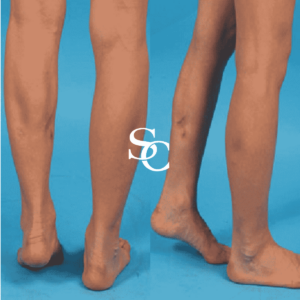 Leg Liposuction Before And After