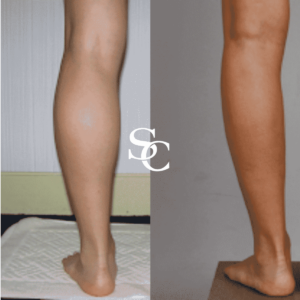 Leg Liposuction Treatment