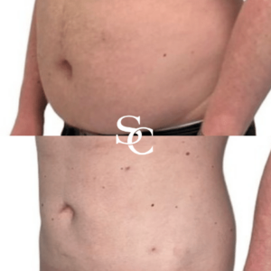 Stomach Liposuction Treatment