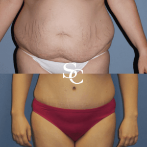 Stomach Liposuction Treatment in Melbourne