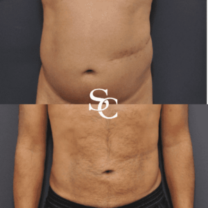 Stomach Liposuction Result