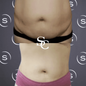 Stomach Liposuction Expert Doctor