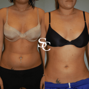 Stomach Liposuction Before And After