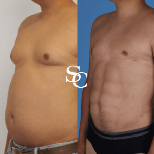 Stomach Liposuction Clinic In Melbourne