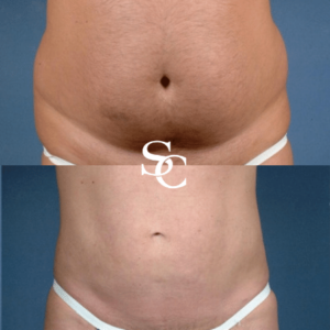 Stomach Liposuction Melbourne